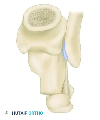 Z -SHAPED CALCANEAL OSTEOTOMY Surgical Diagram