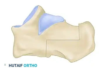 Z -SHAPED CALCANEAL OSTEOTOMY Surgical Diagram