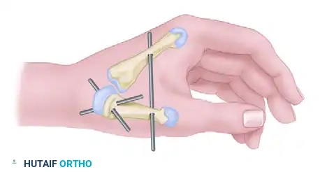BR to EDC and EPL Transfer Overview