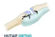 Volar Plate Capsuloplasty Diagram