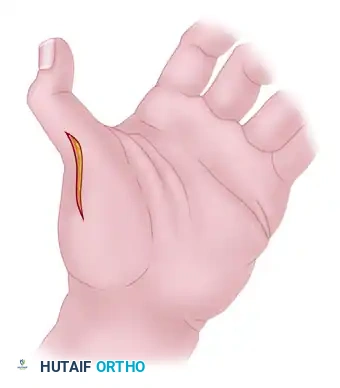 Thumb CMC Fusion with K-wires
