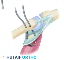 Volar Plate Suturing Detail