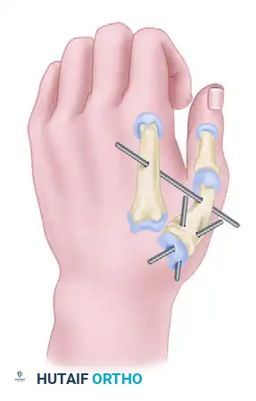 Thumb Incision for Capsuloplasty