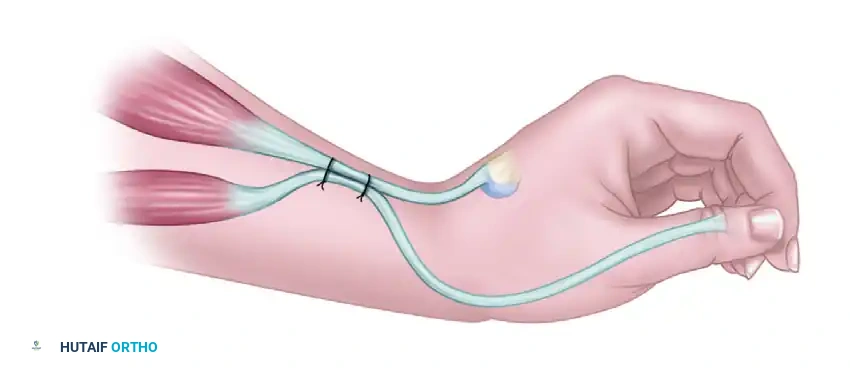 ECRL to FDP Transfer