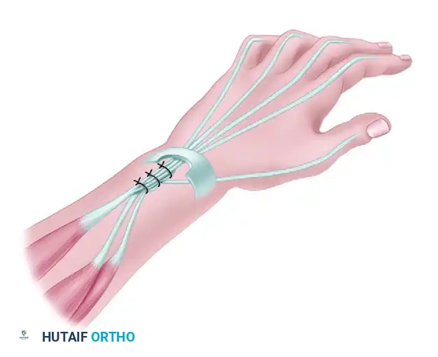 EDC Tensioning Detail