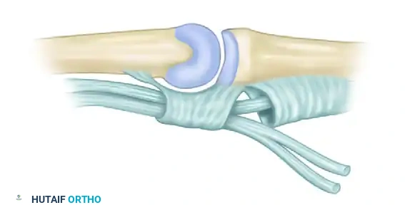 Zancolli Lasso Procedure