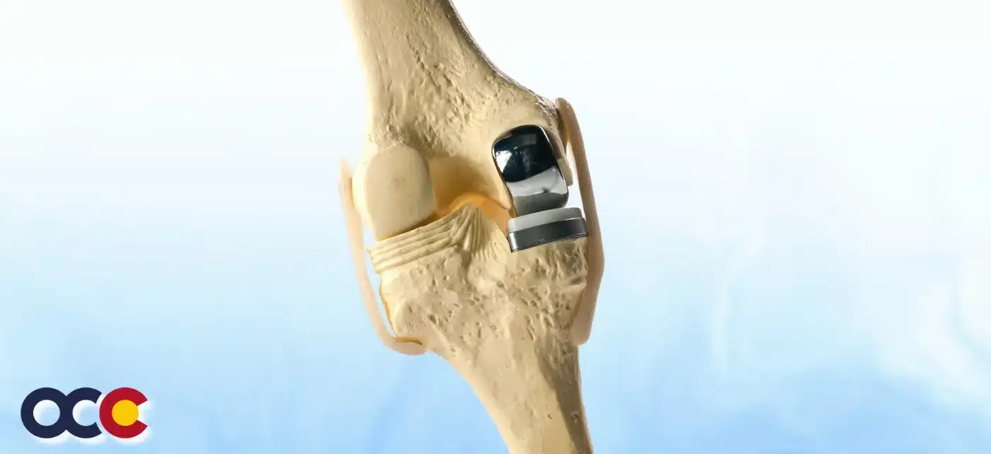 Unicompartmental Knee (UKA) Implant Set
