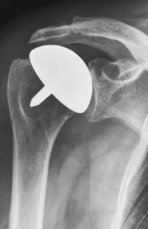 Shoulder Hemiarthroplasty Humeral Stem