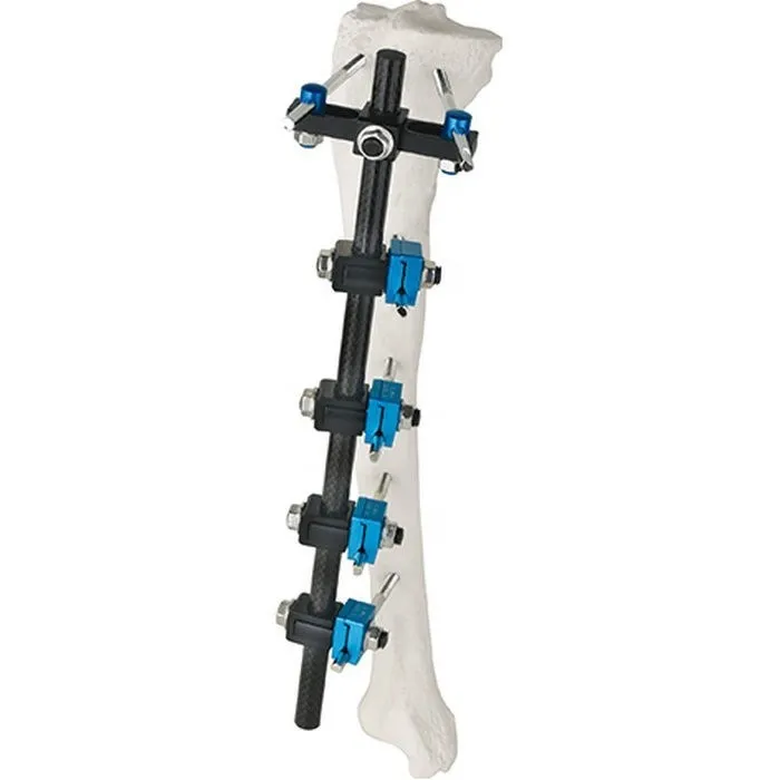 Monolateral Rail External Fixator