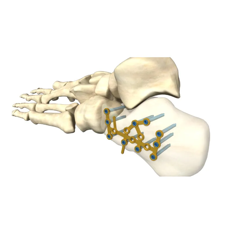 Calcaneal Locking Plate (Perimeter)