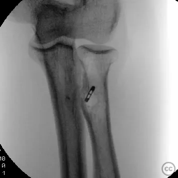 Distal Biceps Cortical Button