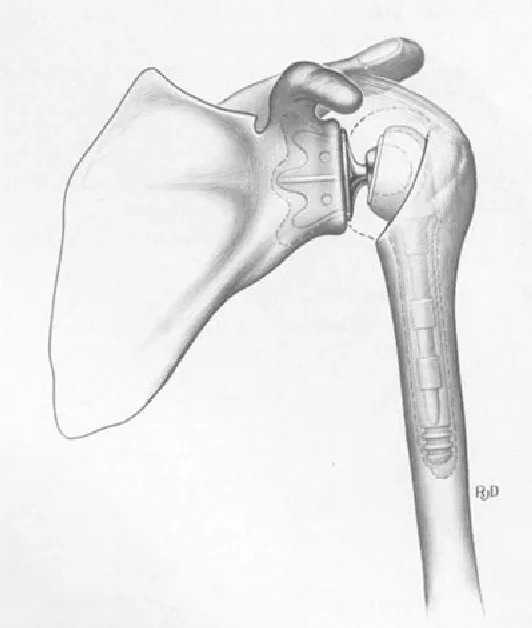 Reverse Total Shoulder Prosthesis