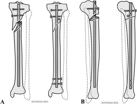 Poller (Blocking) Screws