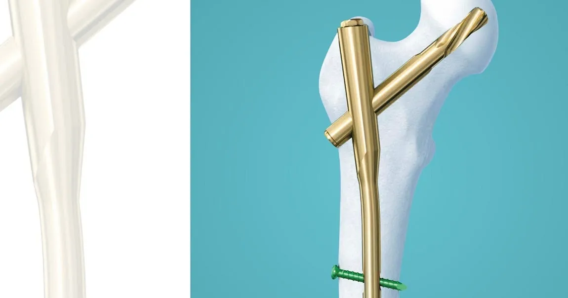 Proximal Femoral Nail Antirotation (PFNA)