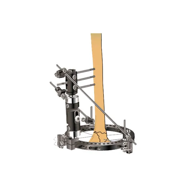 Hybrid External Fixator