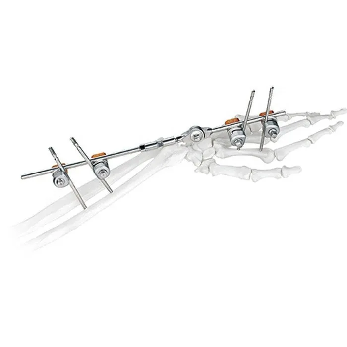 Delta Frame External Fixator (Wrist)