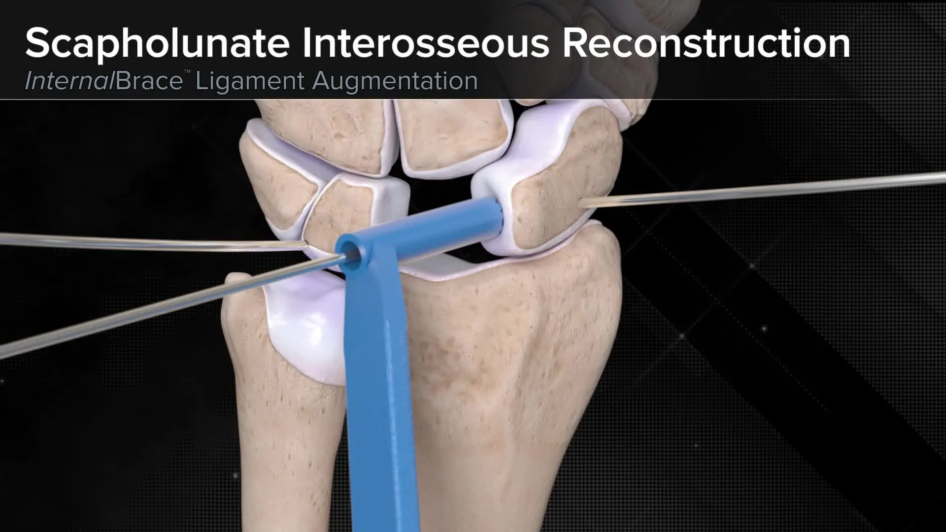 Scapholunate Reconstruction Screw (Dorsal)