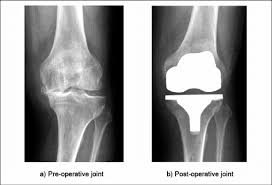 أفضل 15 قصة وتجارب لمرضى استبدال الركبة