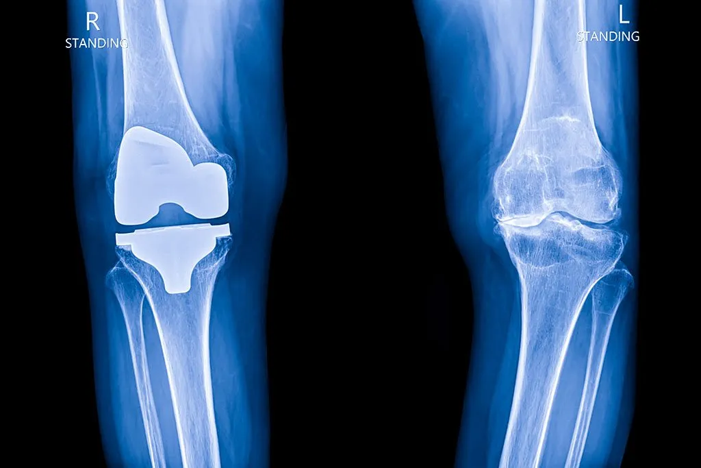 Orthopedic Oncology cases Ewing sarcoma