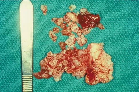 Basic Science 2000 Practice Questions: Set 1 (Solved) - Figure 32