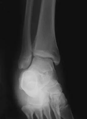 Foot & Ankle 2006 Practice Questions: Set 1 (Solved) - Figure 12