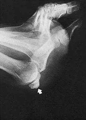 Foot & Ankle 2006 Practice Questions: Set 1 (Solved) - Figure 2