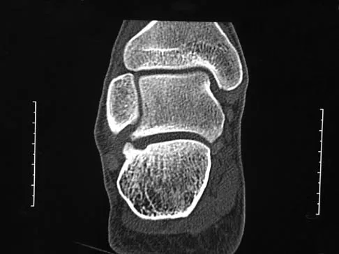 Foot & Ankle Board Review 2006: High-Yield MCQs (Set 2) - Figure 11