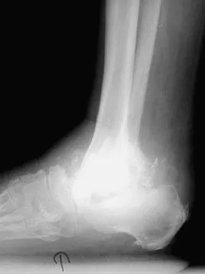 Foot & Ankle Board Review 2006: High-Yield MCQs (Set 2) - Figure 17