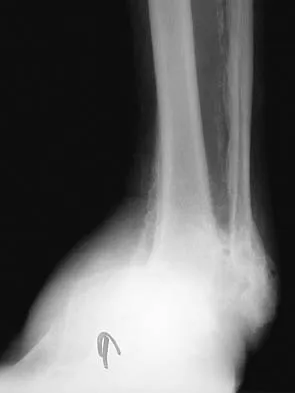 Foot & Ankle Board Review 2006: High-Yield MCQs (Set 2) - Figure 18
