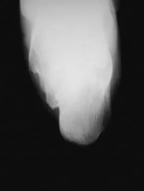 Foot & Ankle Board Review 2006: High-Yield MCQs (Set 2) - Figure 28