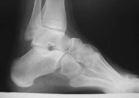 Foot & Ankle Board Review 2006: High-Yield MCQs (Set 2) - Figure 31