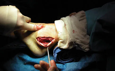 Foot & Ankle Board Review 2006: High-Yield MCQs (Set 2) - Figure 4