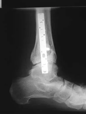 Click to enlarge Foot & Ankle 2006 Practice Questions: Set 3 (Solved) - Figure 2