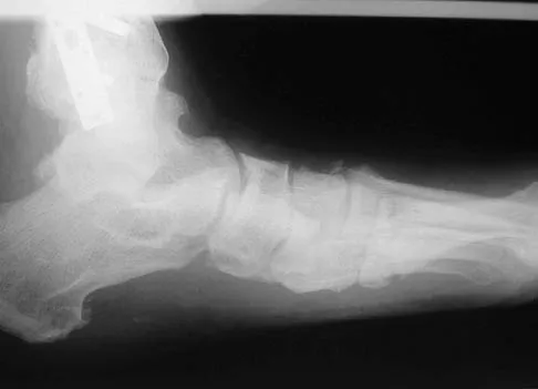 Click to enlarge Foot & Ankle 2006 Practice Questions: Set 3 (Solved) - Figure 4