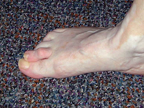 Foot & Ankle Board Review 2006: High-Yield MCQs (Set 4) - Figure 2