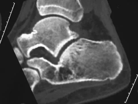 Foot & Ankle Board Review 2006: High-Yield MCQs (Set 4) - Figure 6