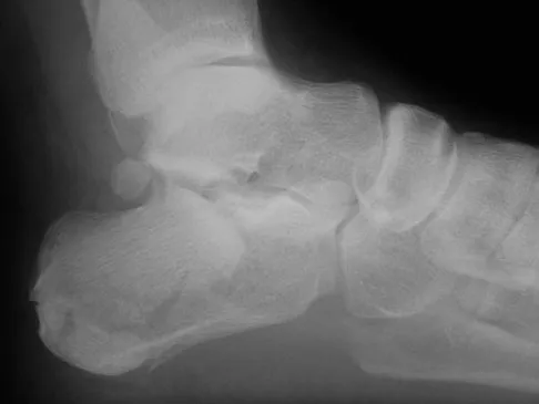 Foot & Ankle 2009 Practice Questions: Set 1 (Solved) - Figure 32