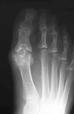 Foot & Ankle 2009 Practice Questions: Set 1 (Solved) - Figure 33