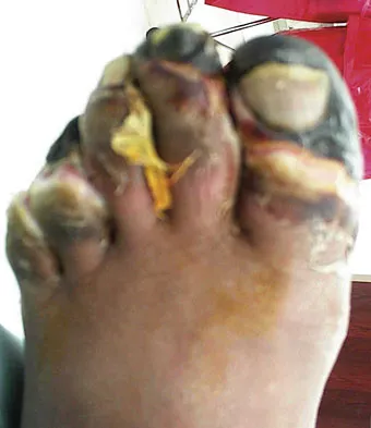 Foot & Ankle 2009 Practice Questions: Set 1 (Solved) - Figure 35