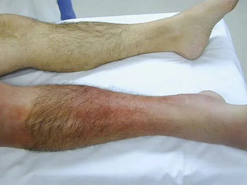 AAOS/ABOS Foot & Ankle Board Review (Set 2): Ankle Fractures, Hallux Valgus & PTTD MCQs | 2009