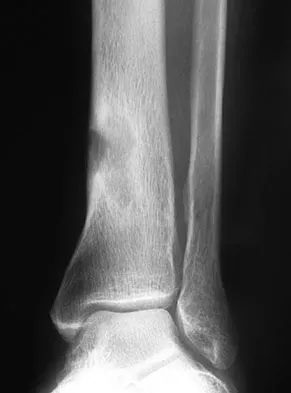 Foot & Ankle Board Review 2009: High-Yield MCQs (Set 2) - Figure 29