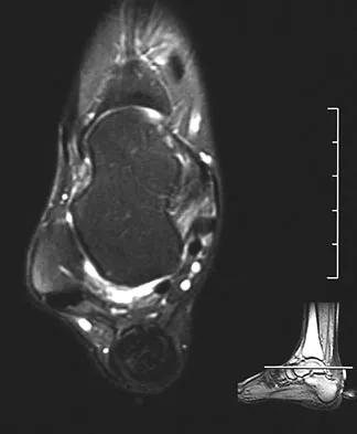 Foot & Ankle Board Review 2009: High-Yield MCQs (Set 2) - Figure 30
