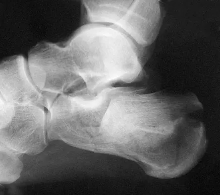Foot & Ankle Board Review 2009: High-Yield MCQs (Set 2) - Figure 32