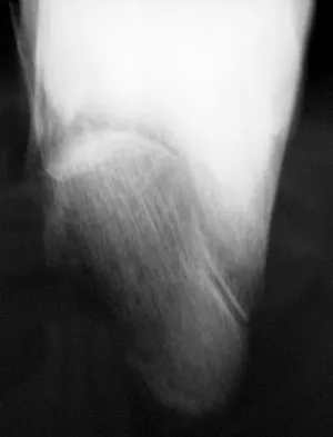 Foot & Ankle Board Review 2009: High-Yield MCQs (Set 2) - Figure 33