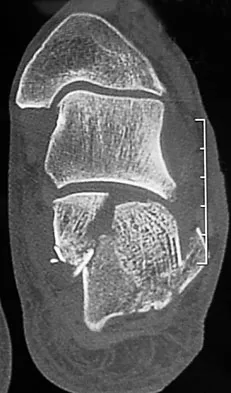 Foot & Ankle Board Review 2009: High-Yield MCQs (Set 2) - Figure 36