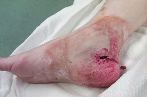 Foot & Ankle Board Review 2009: High-Yield MCQs (Set 2) - Figure 6