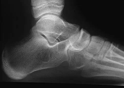 Foot & Ankle Board Review 2009: High-Yield MCQs (Set 4) - Figure 13