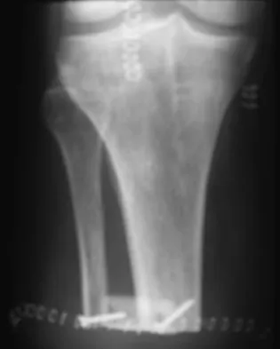 Foot & Ankle Board Review 2009: High-Yield MCQs (Set 4) - Figure 14