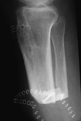 Foot & Ankle Board Review 2009: High-Yield MCQs (Set 4) - Figure 15