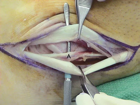 Foot & Ankle Board Review 2009: High-Yield MCQs (Set 4) - Figure 23